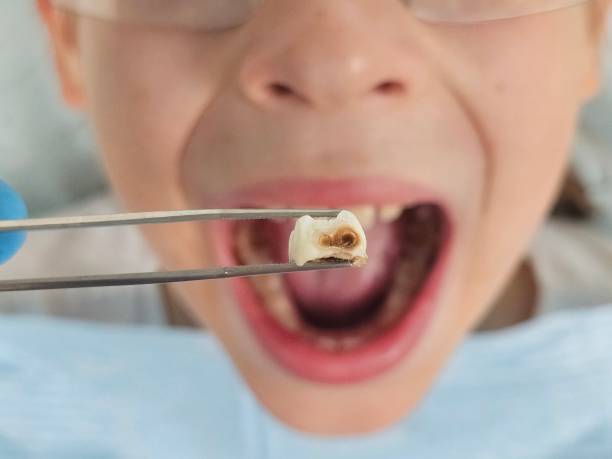 Emergency Dental Filling Replacement in NC